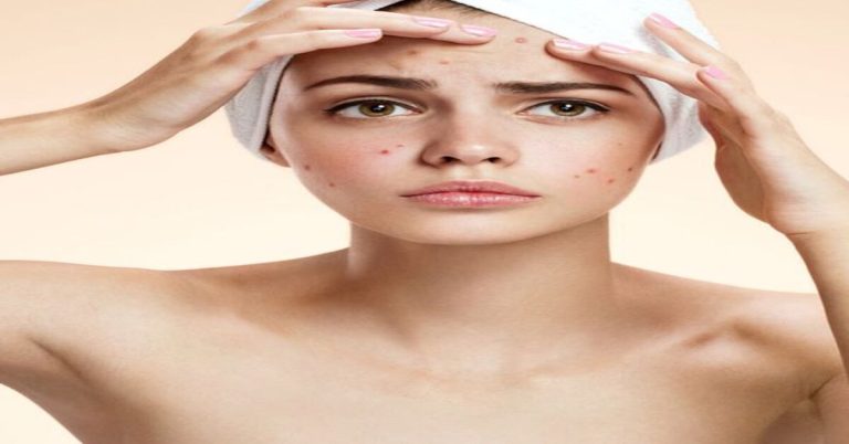 Can Saunas Treat Acne? (Break Outs, Pores, Pimples, & More!)